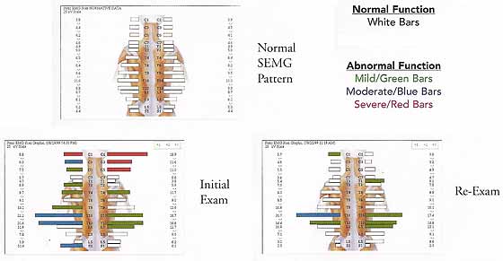 Surface Electromyography (SEMG Scan)